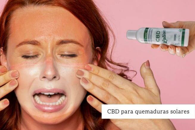 cbd para quemaduras solares